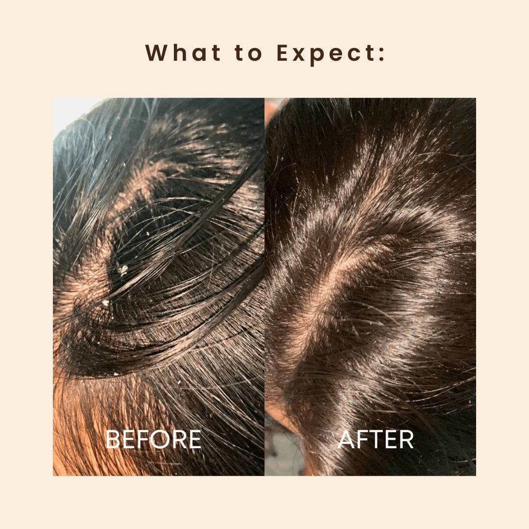 Anti Dandruff Shampoo